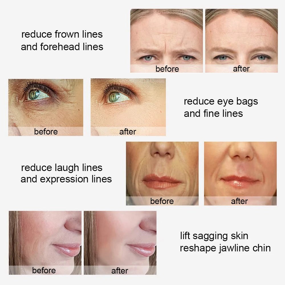 RF Facial Skin Tightening Device