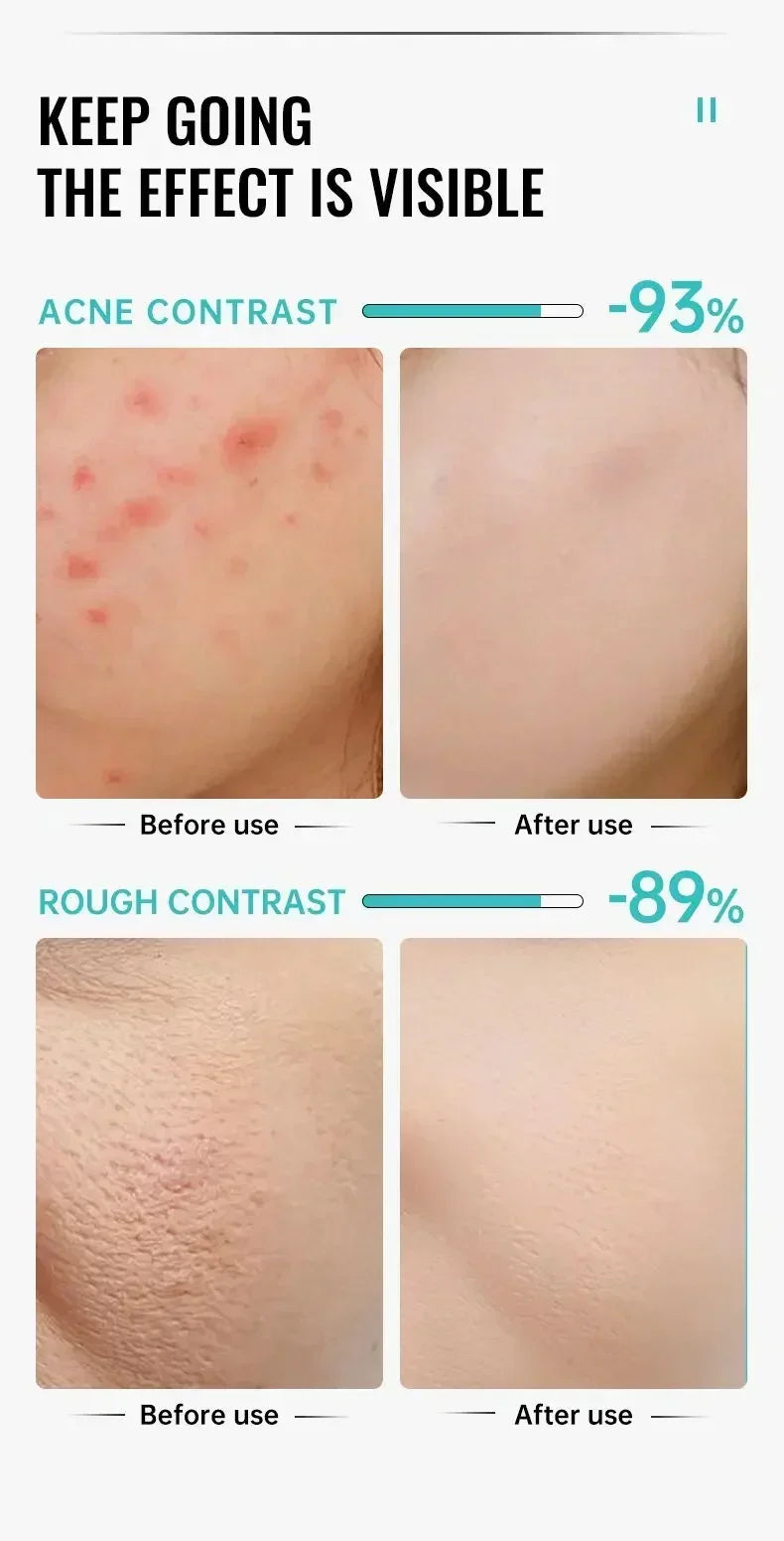 Salicylic Acid Acne Cream