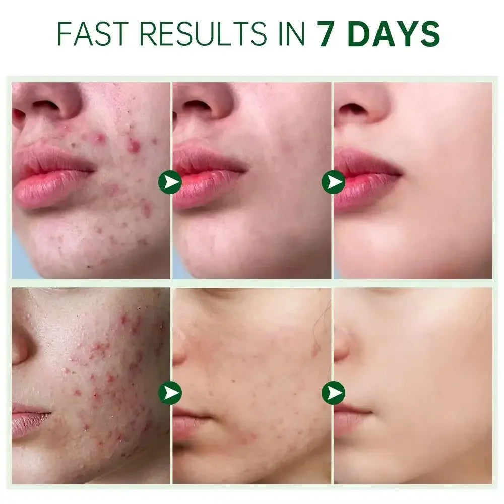 Salicylic Acid Acne Cream