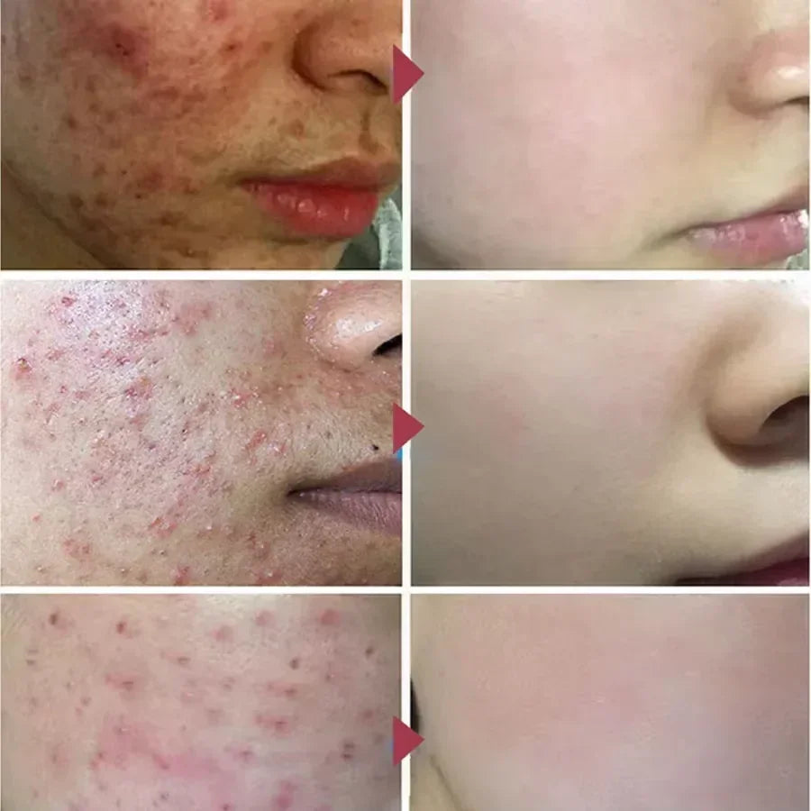 Salicylic Acid Acne Cream