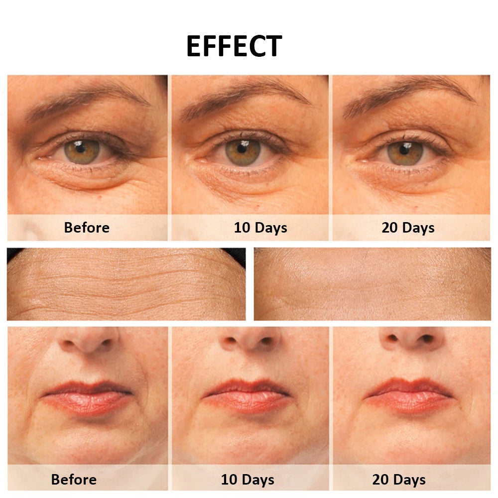 RF Facial Skin Tightening Device