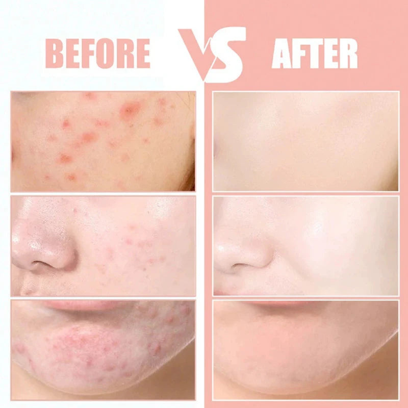 Invisible Acne Patches