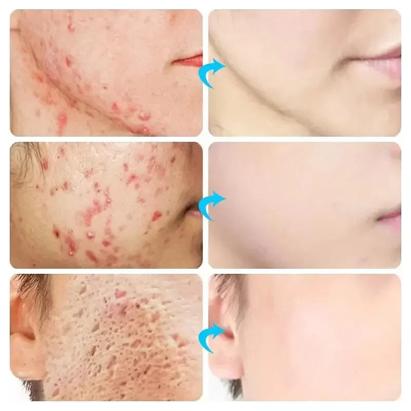 Salicylic Acid Acne Cream