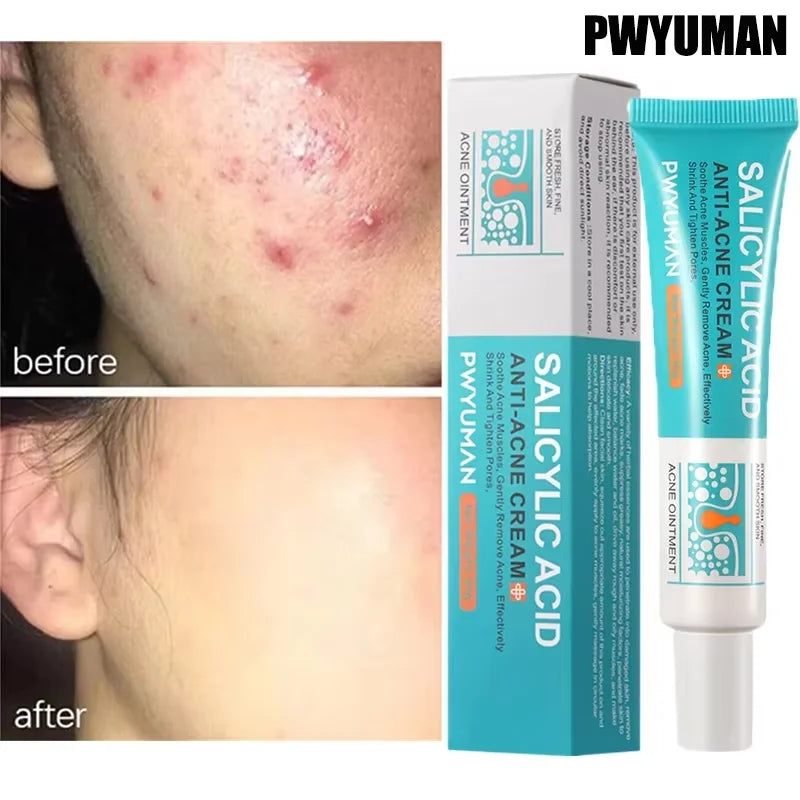 Salicylic Acid Acne Cream