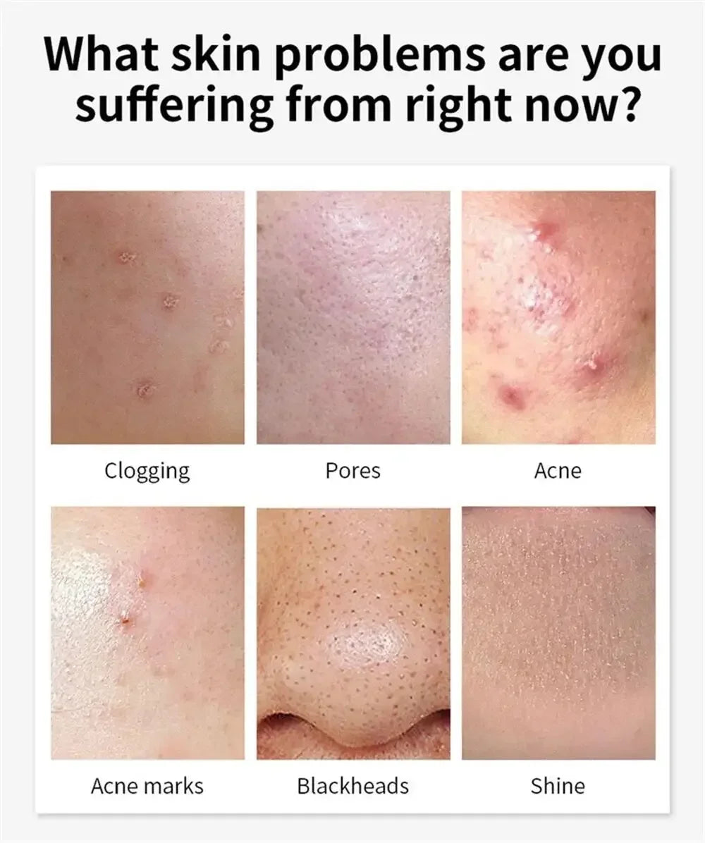 Salicylic Acid Acne Cream