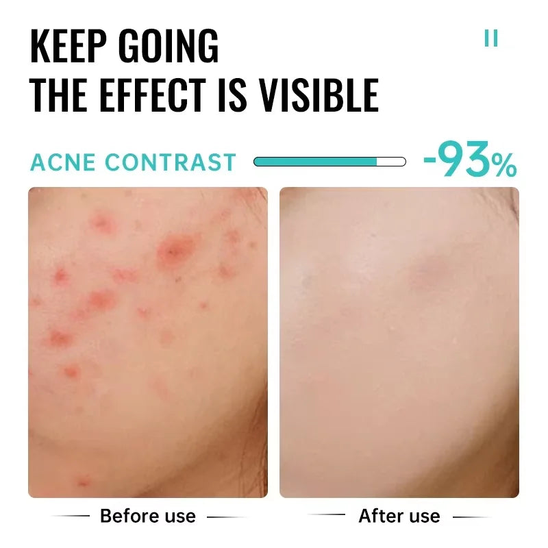 Salicylic Acid Acne Cream