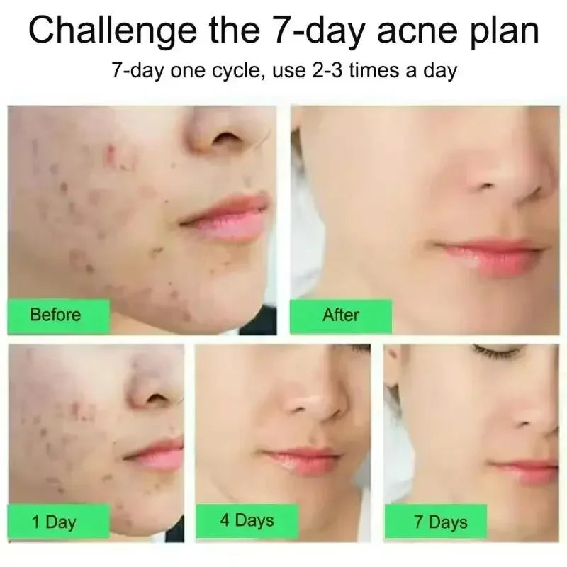 Salicylic Acid Acne Cream