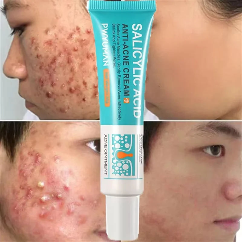 Salicylic Acid Acne Cream