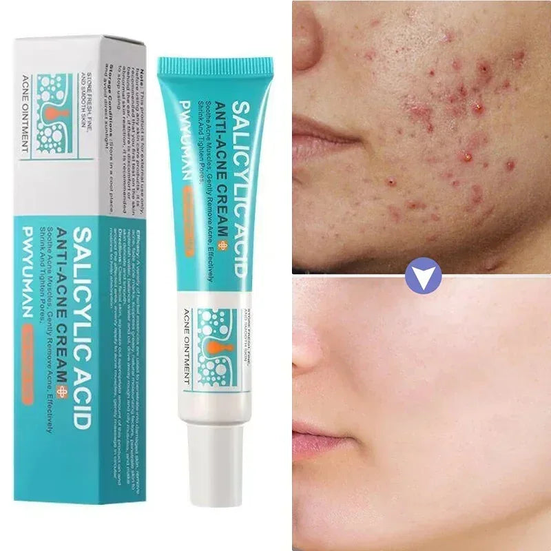 Salicylic Acid Acne Cream